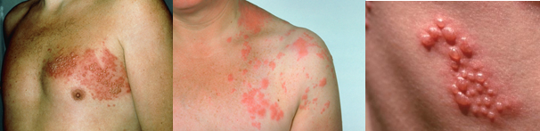 shingles rash blisters example CLL Support